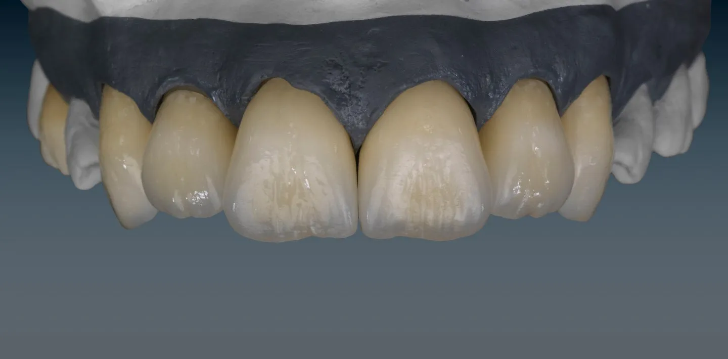 Layered ceramic anterior crowns on a working model