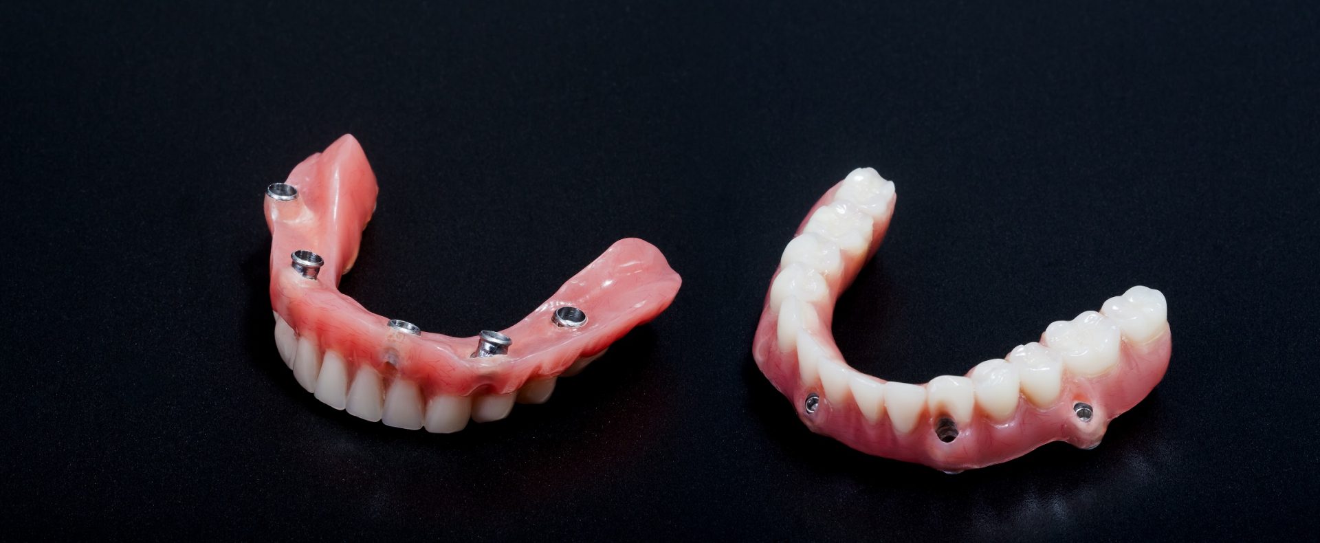 Hbrida ptesis dental sobre implantes
